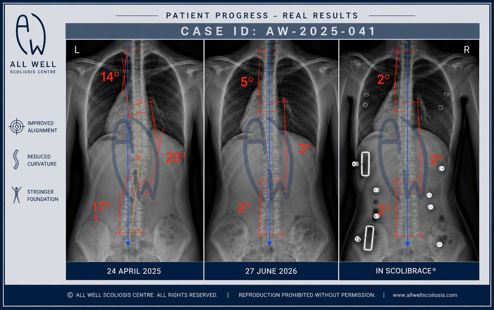 Three scoliosis X-rays showing a 17-year-old patient's improvement from 14° and 25° curves with 17 mm pelvic imbalance to 5° and 3°, and 2° in-brace correction using ScoliBrace and ScoliBalance exercises.