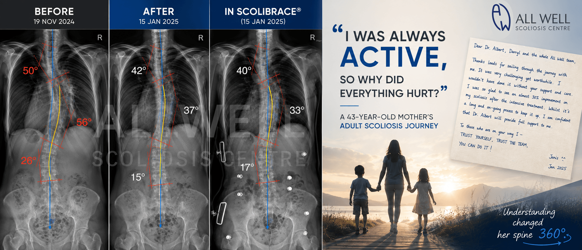 Before, after, and in-brace scoliosis X-rays of a 43-year-old mother showing improvement from 50°/56°/26° to 42°/37°/15° and 40°/33°/17° with adult scoliosis rehabilitation and ScoliBrace treatment.