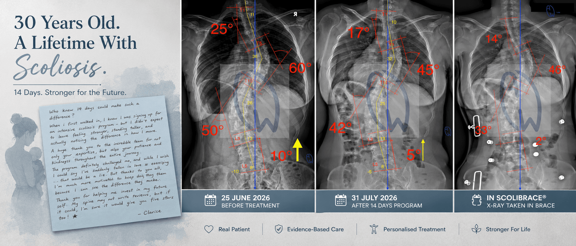 30-year-old woman with adult scoliosis showing three side-by-side X-rays before, after treatment, and in ScoliBrace®