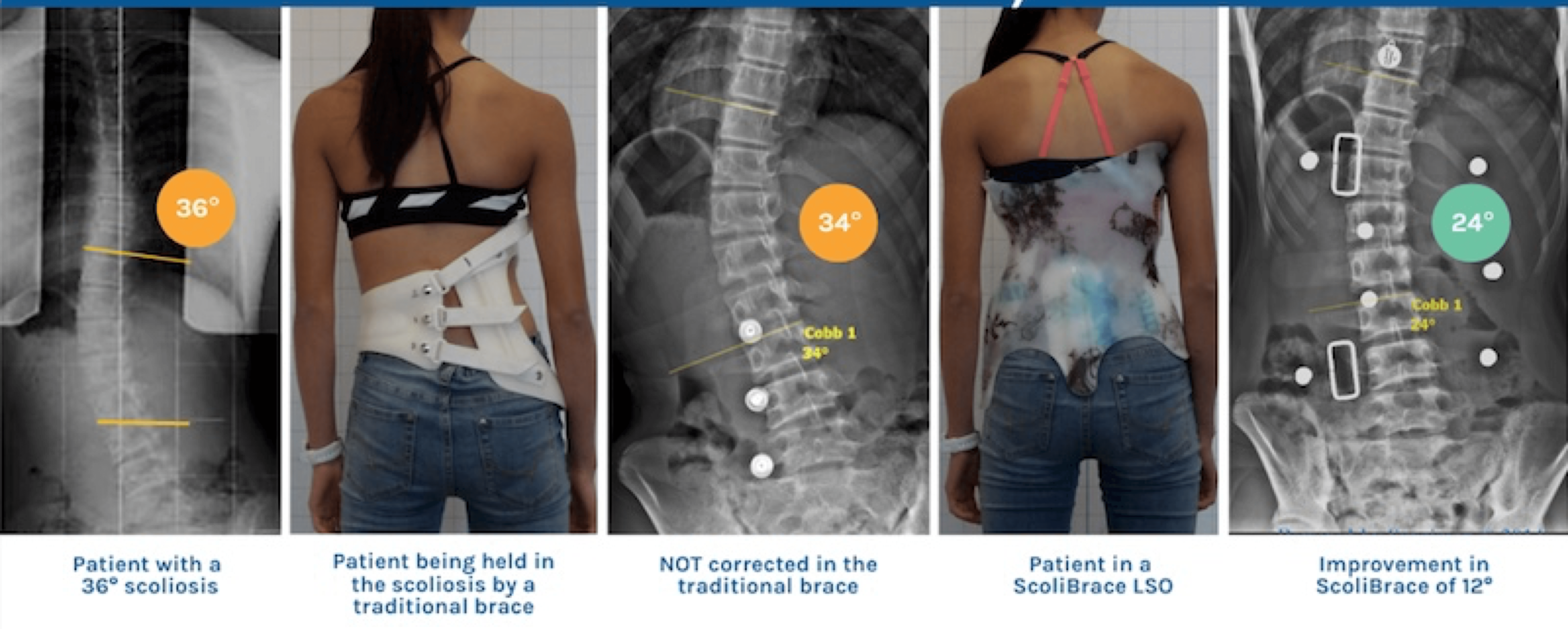scoliosis brace singapore