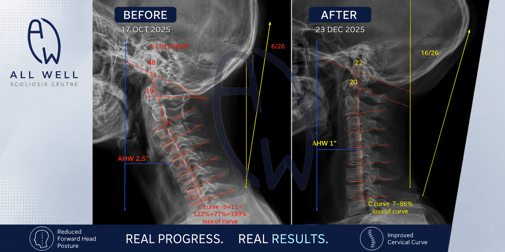 Side-by-side cervical spine X-rays showing forward head posture improvement from 2.5 inches to 1 inch and restoration of cervical lordosis during an ongoing Cervigard Therapy rehabilitation program.