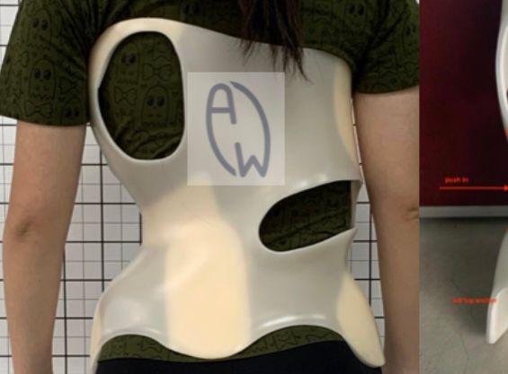 Bracing for Scoliosis