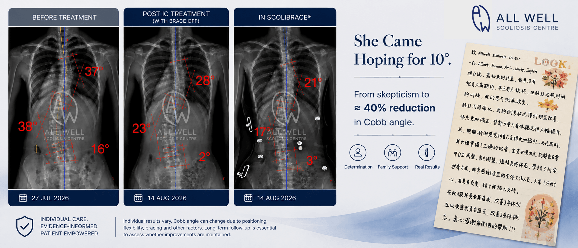 Three scoliosis X-rays showing Cobb angle changes before treatment, after intensive treatment with brace off, and in ScoliBrace