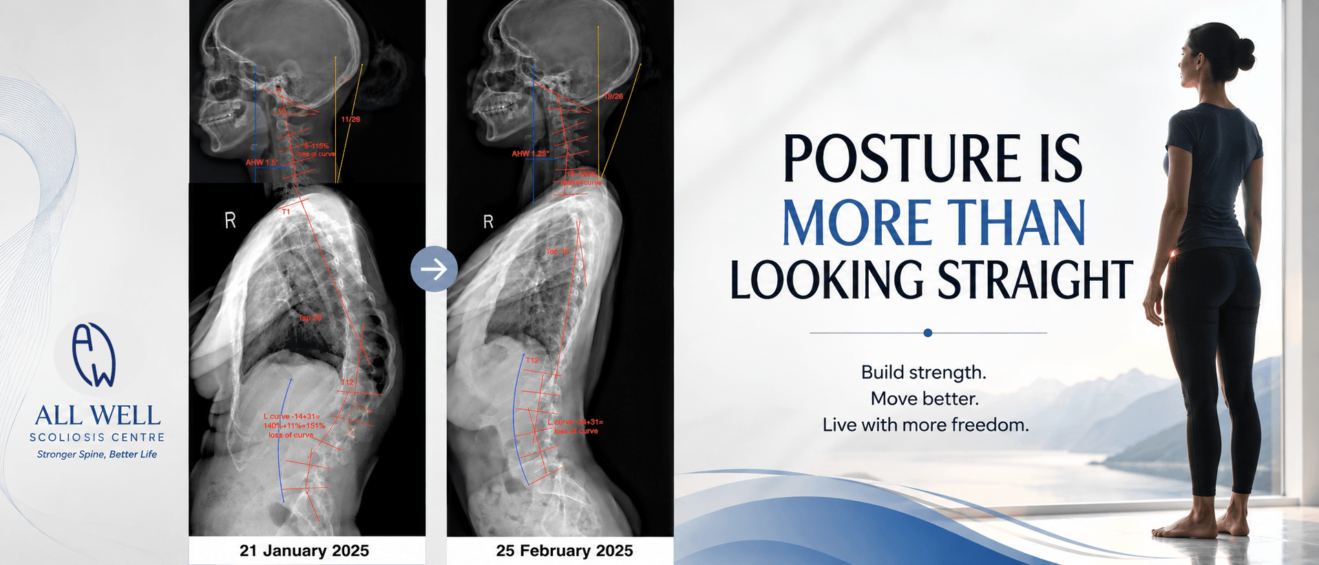 Lateral standing X-ray comparison showing changes in spinal posture and alignment after scoliosis rehabilitation between January and February 2025