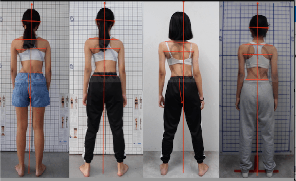 How to Fix Scoliosis Rotation with Core Activation and Breathing Techniques