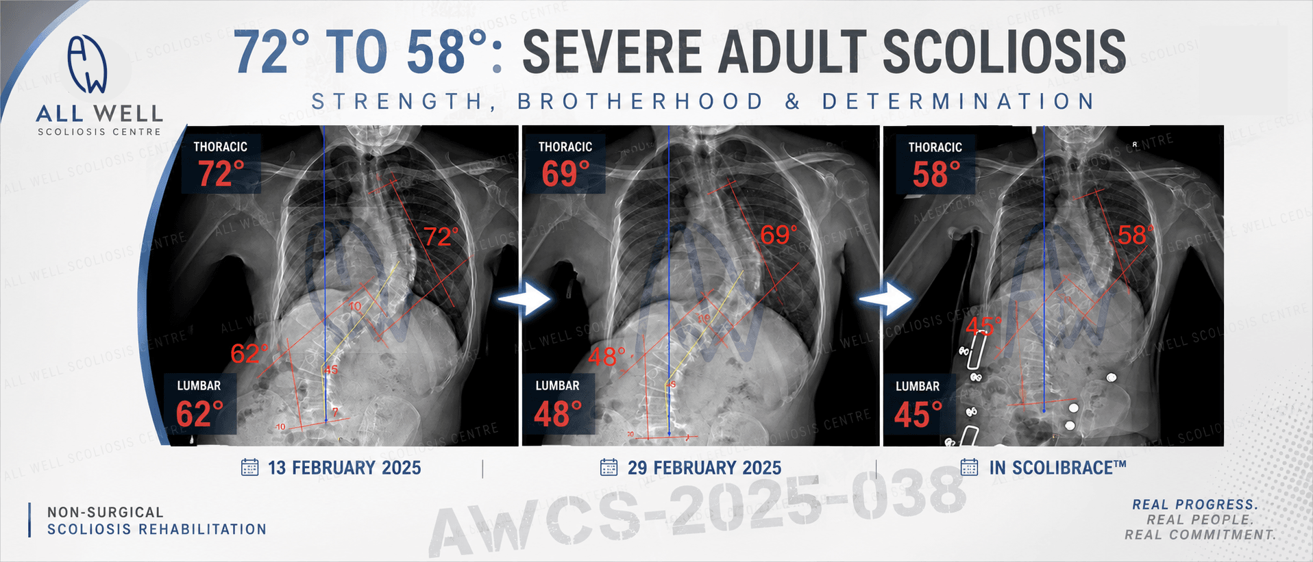 X-ray comparison of a 38-year-old adult scoliosis patient showing correction from 72° thoracic and 62° lumbar scoliosis to 58° and 45° in ScoliBrace during intensive rehabilitation.