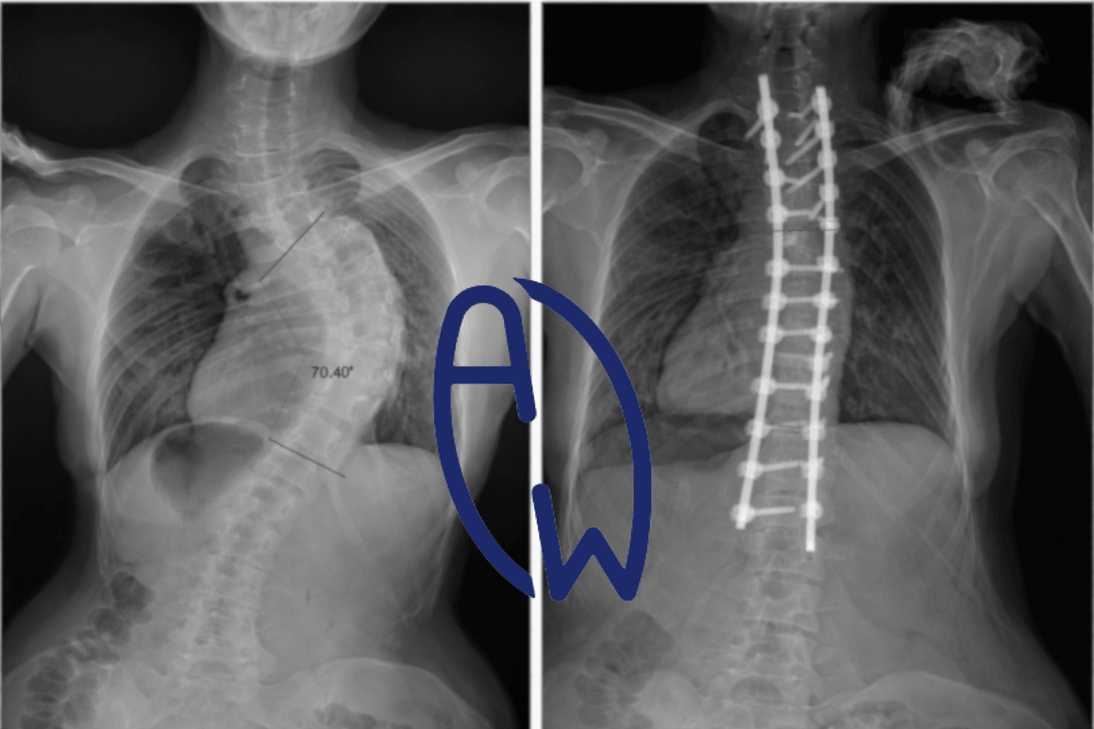 Spine X-Ray with Rods: How Scoliosis Surgery Affects Lung Capacity and Neck Alignment