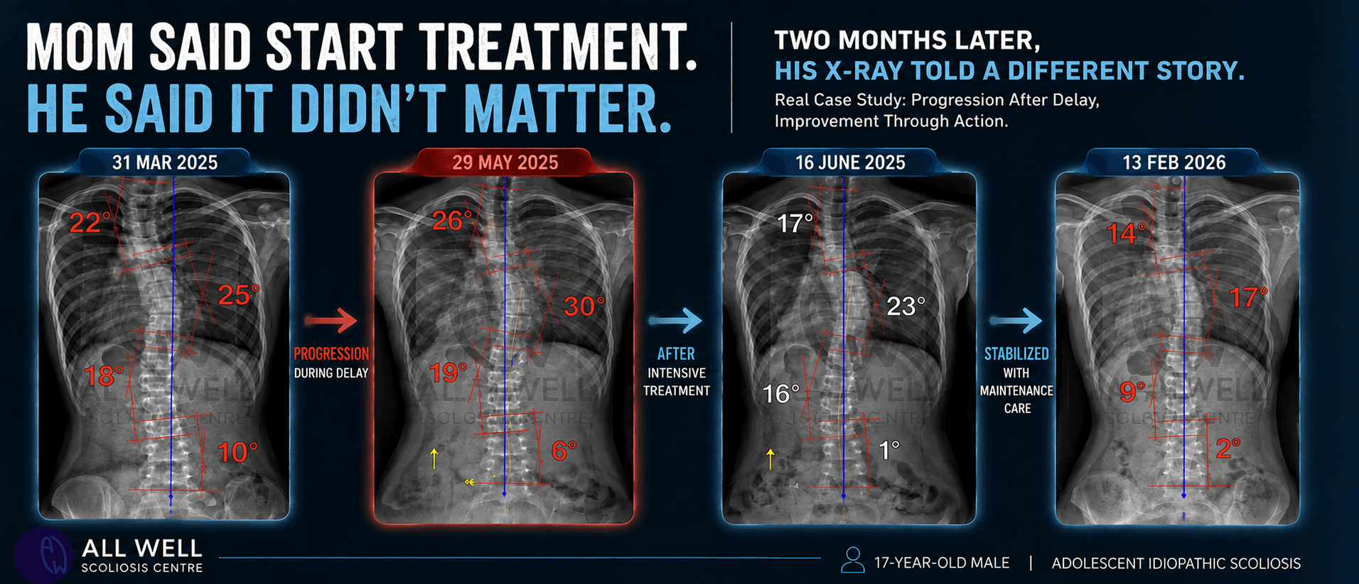 Four scoliosis X-rays from 2025 to 2026 showing curve progression before intensive treatment and significant improvement with rehabilitation, maintenance care, and ongoing monitoring in a 17-year-old male.