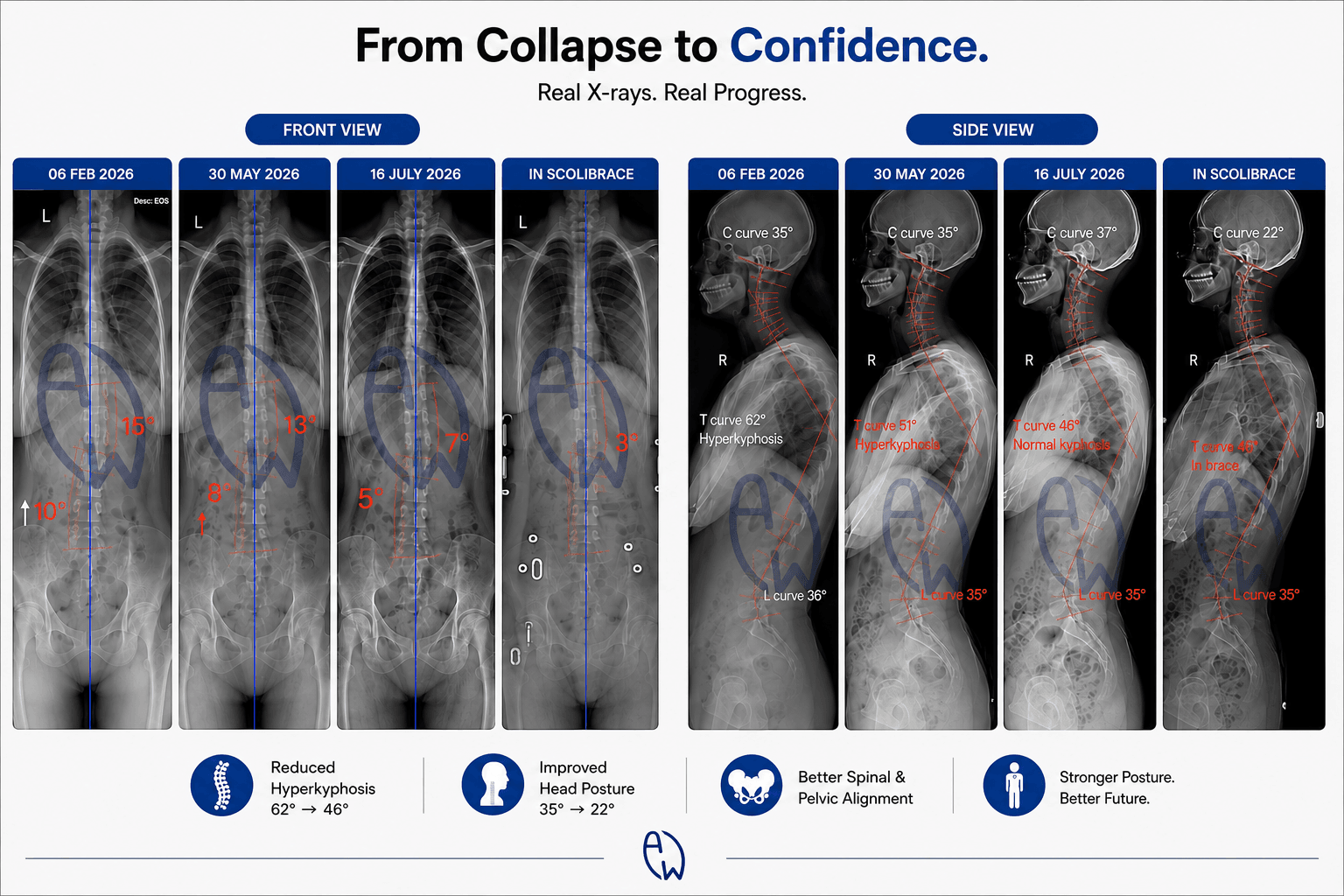 X-ray comparison showing improvement of a 62° thoracic hyperkyphosis, forward head posture, and mild scoliosis following intensive rehabilitation and corrective ScoliBrace treatment at All Well Scoliosis Centre Singapore.