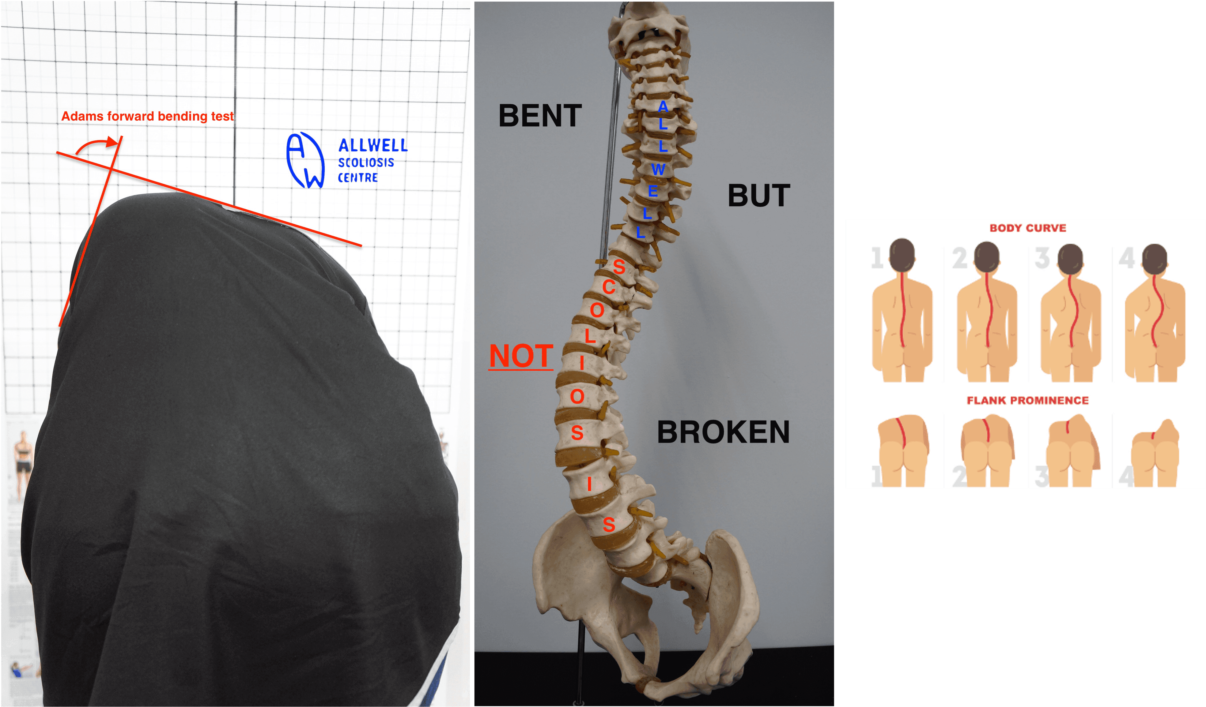 adams test, bent but not broken, and spine illustration
