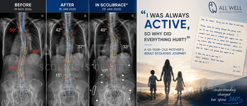Before, after, and in-brace scoliosis X-rays of a 43-year-old mother showing improvement from 50°/56°/26° to 42°/37°/15° and 40°/33°/17° with adult scoliosis rehabilitation and ScoliBrace treatment.