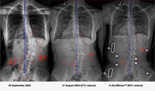 14-Day Intensive Scoliosis Treatment Program