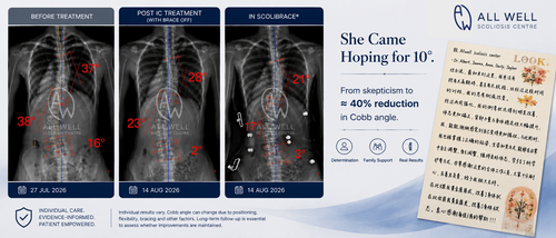 Three scoliosis X-rays showing Cobb angle changes before treatment, after intensive treatment with brace off, and in ScoliBrace
