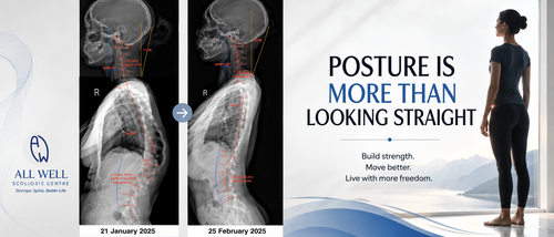 Lateral standing X-ray comparison showing changes in spinal posture and alignment after scoliosis rehabilitation between January and February 2025