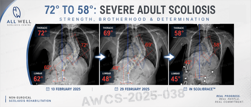 X-ray comparison of a 38-year-old adult scoliosis patient showing correction from 72° thoracic and 62° lumbar scoliosis to 58° and 45° in ScoliBrace during intensive rehabilitation.
