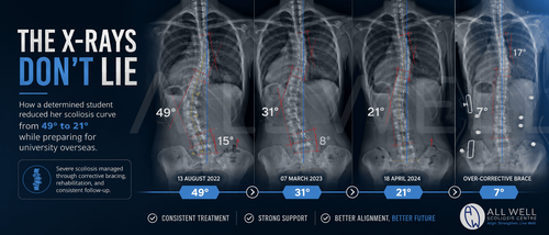 Sequential scoliosis X-rays showing reduction of a severe 49-degree spinal curve to 21 degrees over two years with bracing and scoliosis rehabilitation.
