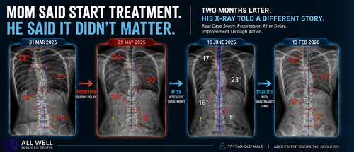 Four scoliosis X-rays from 2025 to 2026 showing curve progression before intensive treatment and significant improvement with rehabilitation, maintenance care, and ongoing monitoring in a 17-year-old male.